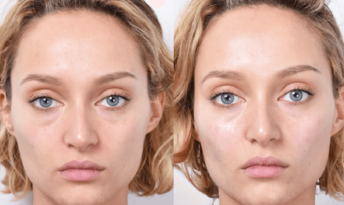 before after plasma facial rejuvenation mississauga oakville